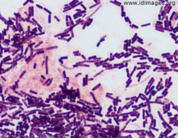 Figure 1.  <i>Bacillus cereus</i> group (not <i>anthracis</i>), gram stain of growth from vitrectomy specimen.
