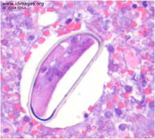Figure 1. An adult worm of <i>Paragonimus kellicotti</i> is shown in a chitinous capsule within a cystic cavity (HE stain, 400x magnification). 