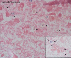 <p>A man with HIV infection and AIDS reported four weeks of pain on defecation. The prostate was boggy and tender and pyuria was noted, despite administration of antibiotics.  Urine cultures were sterile.  A prostate abscess was identified and aspirated.  Hematoxylin and eosin stain of the aspirate is shown.</p>
<p><b>The most likely diagnosis is which of the following?</b></p>